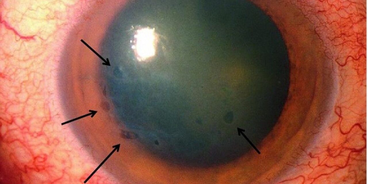 Aphakic Bullous Keratopathy: A Complication From an Era Before Modern Lens Implants