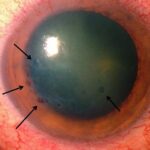Clinical eye photograph illustrating Aphakic Bullous Keratopathy