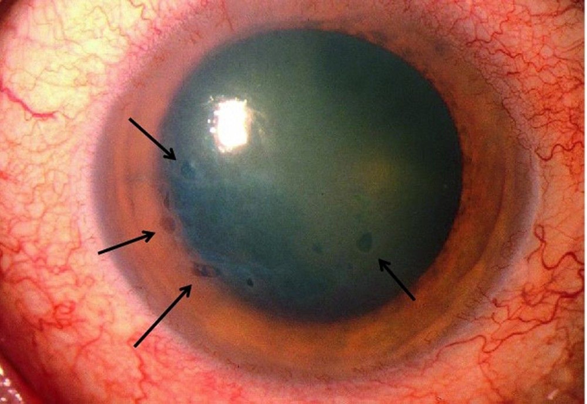 Clinical eye photograph illustrating Aphakic Bullous Keratopathy