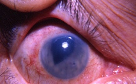 Clinical eye photograph illustrating Aphakic Bullous Keratopathy