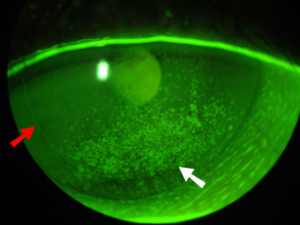 Clinical eye photograph illustrating Aqueous Deficient Dry Eye