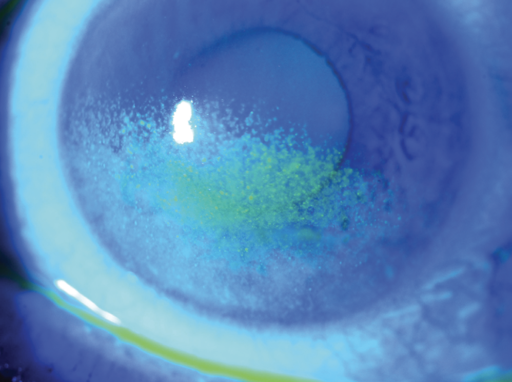 Clinical eye photograph illustrating Aqueous Deficient Dry Eye
