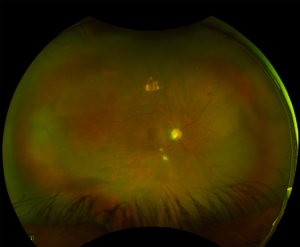 Clinical image illustrating Aqueous Flare (Tyndall Effect)
