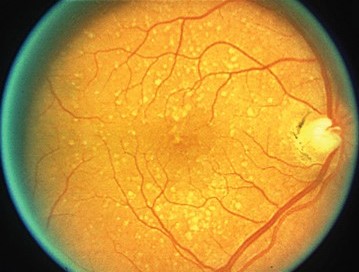 Clinical eye photograph illustrating Areds2 Supplements