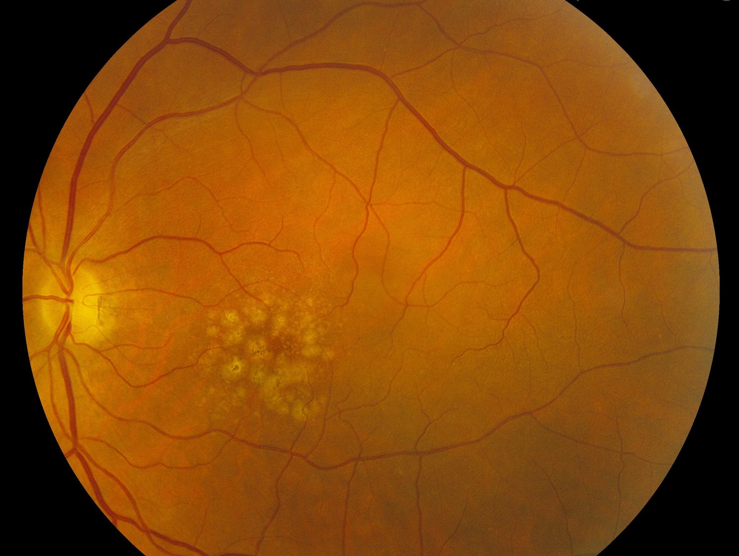 Clinical eye photograph illustrating Areds2 Supplements