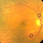 Clinical eye photograph illustrating Arteriovenous Crossing Signs Gunn Salus Bonnet
