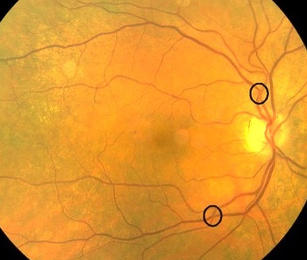 Clinical eye photograph illustrating Arteriovenous Crossing Signs Gunn Salus Bonnet