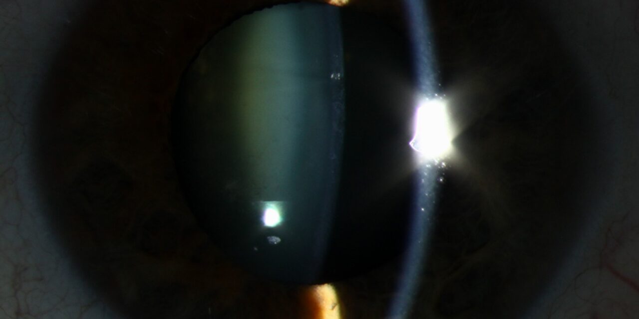 Atopic Cataract: The Shield-Like Opacity in Young Patients With Eczema