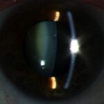 Clinical eye photograph illustrating Atopic Cataract