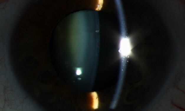 Atopic Cataract: The Shield-Like Opacity in Young Patients With Eczema