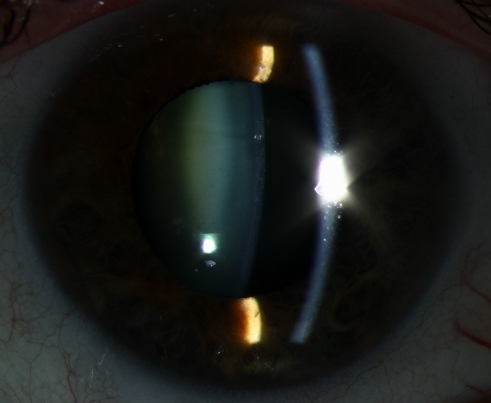 Clinical eye photograph illustrating Atopic Cataract
