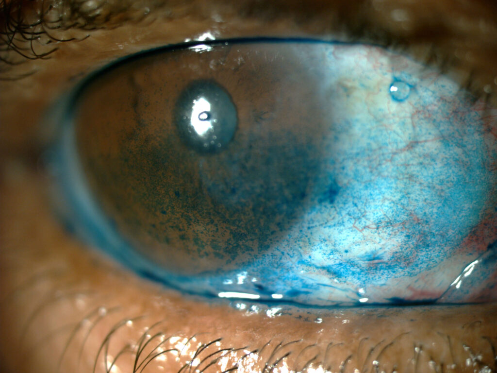 Clinical eye photograph illustrating Autologous Serum Eye Drops