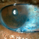 Clinical eye photograph illustrating Autologous Serum Eye Drops