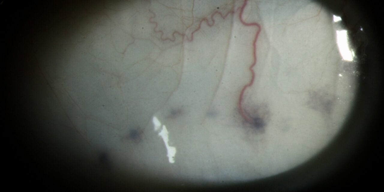 Axenfeld Nerve Loop: The Dark Scleral Bump That Is Not a Melanoma