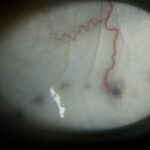 Clinical eye photograph illustrating Axenfeld Nerve Loop