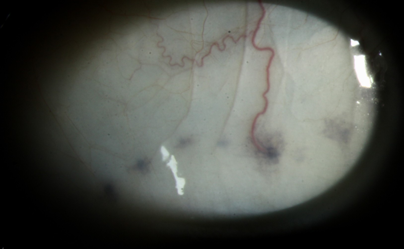 Clinical eye photograph illustrating Axenfeld Nerve Loop