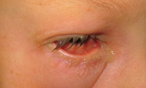 Clinical eye photograph illustrating Bacterial Conjunctivitis Diagnosis Antibiotic Use