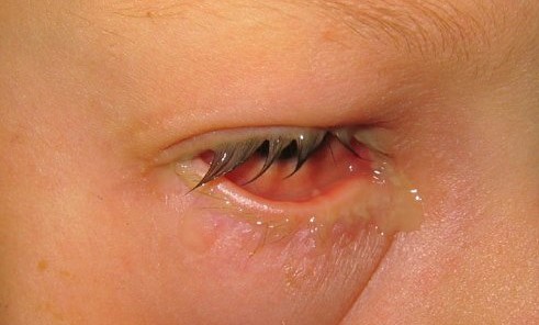 Clinical eye photograph illustrating Bacterial Conjunctivitis Diagnosis Antibiotic Use