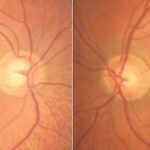 Clinical eye photograph illustrating Bayoneting Nasalization Optic Disc Vessels