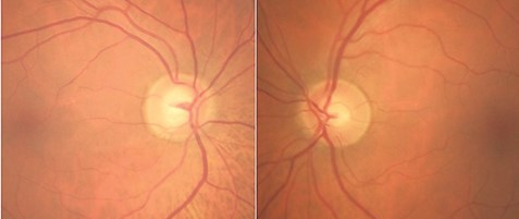 Clinical eye photograph illustrating Bayoneting Nasalization Optic Disc Vessels
