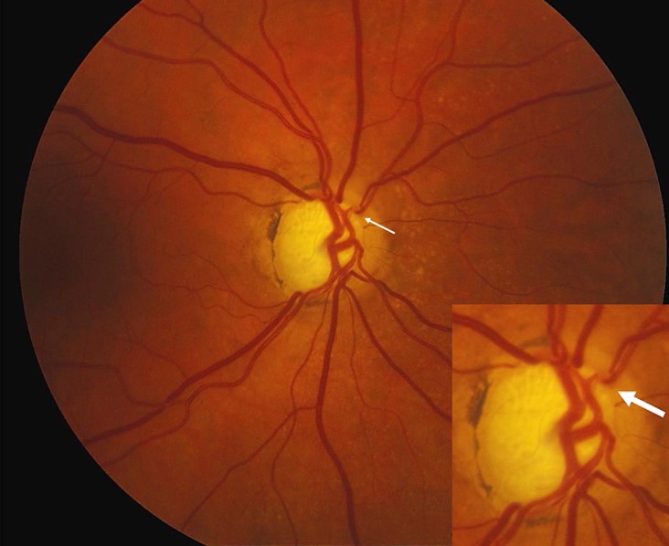 Clinical eye photograph illustrating Bayoneting Nasalization Optic Disc Vessels