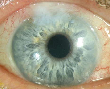 Clinical eye photograph illustrating Bleb Needling Failing Trabeculectomy Technique