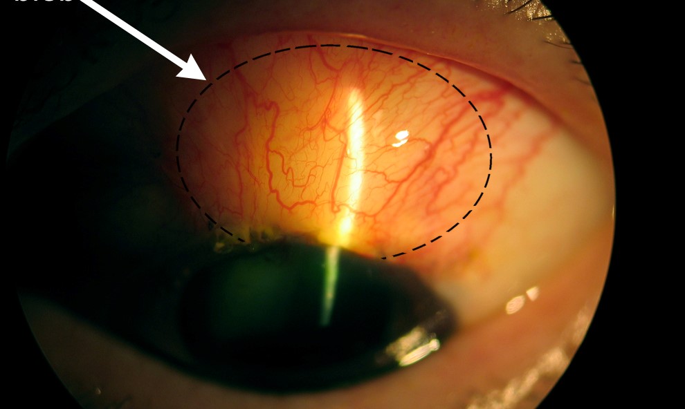 Clinical eye photograph illustrating Bleb Needling Failing Trabeculectomy Technique