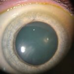 Clinical image illustrating Blepharitis Treatment (figure 1)