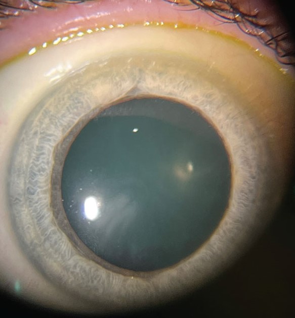 Clinical image illustrating Blepharitis Treatment (figure 1)