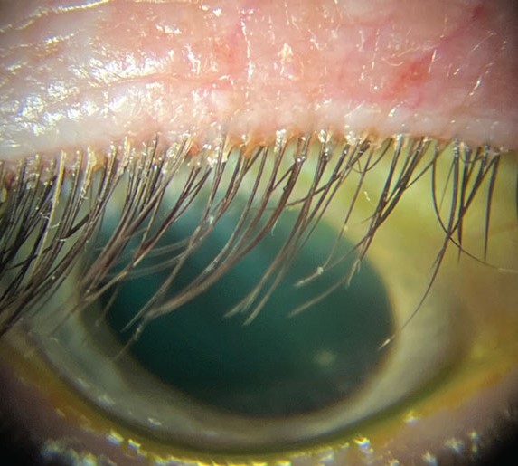 Clinical image illustrating Blepharitis Treatment (figure 2)