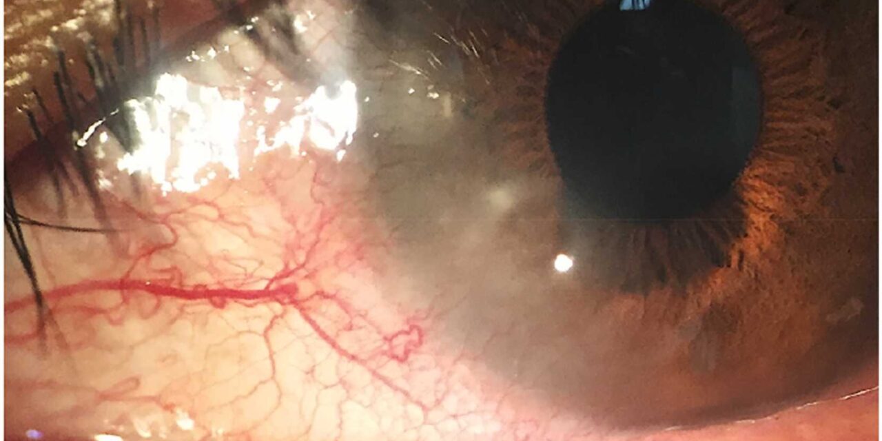 Pediatric Blepharokeratoconjunctivitis: A Chronic Lid-and-Surface Disease That Threatens the Cornea Quietly