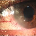 Clinical eye photograph illustrating Blepharokeratoconjunctivitis Pediatric