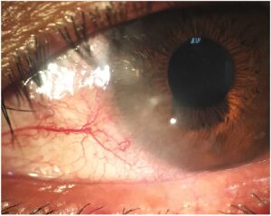 Clinical eye photograph illustrating Blepharokeratoconjunctivitis Pediatric