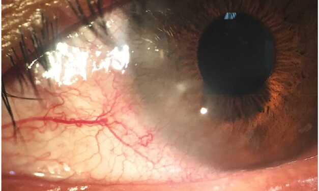 Pediatric Blepharokeratoconjunctivitis: A Chronic Lid-and-Surface Disease That Threatens the Cornea Quietly