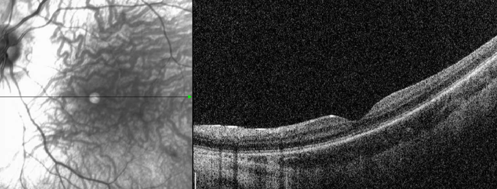 Clinical eye photograph illustrating Blue Cone Monochromacy