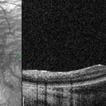 Clinical eye photograph illustrating Blue Cone Monochromacy