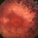 Clinical eye photograph illustrating Bone Spicule Pigmentation Causes Differential
