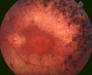 Clinical eye photograph illustrating Bone Spicule Pigmentation Causes Differential