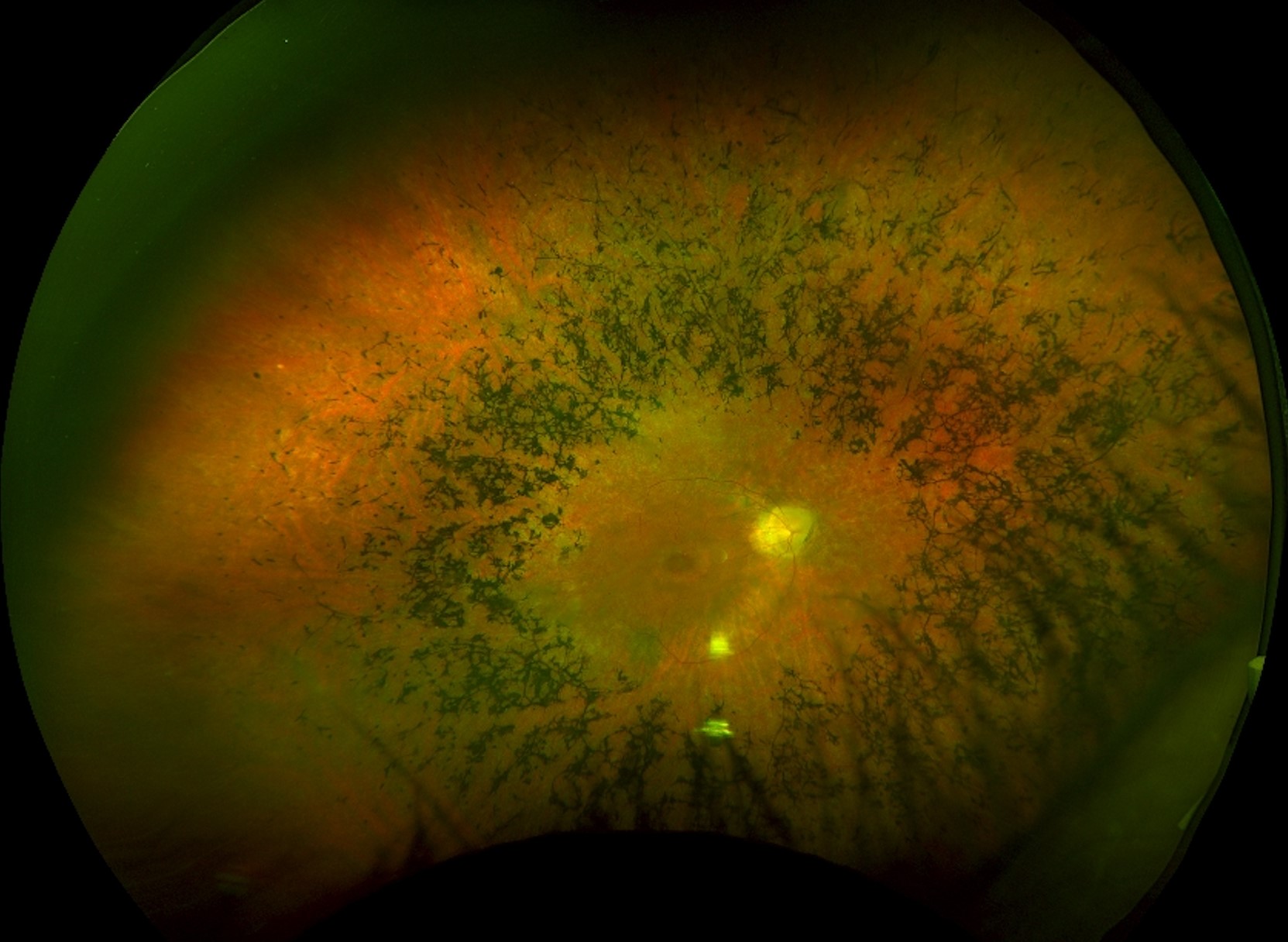 Clinical eye photograph illustrating Bone Spicule Pigmentation Causes Differential