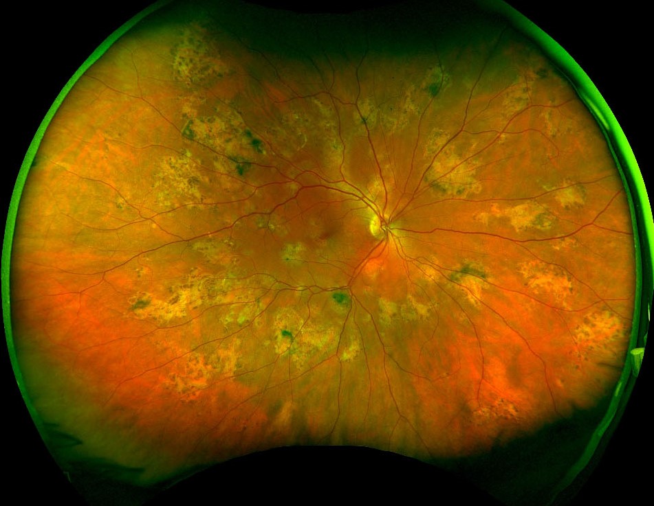 BRAF Inhibitor Uveitis: Vemurafenib and Dabrafenib