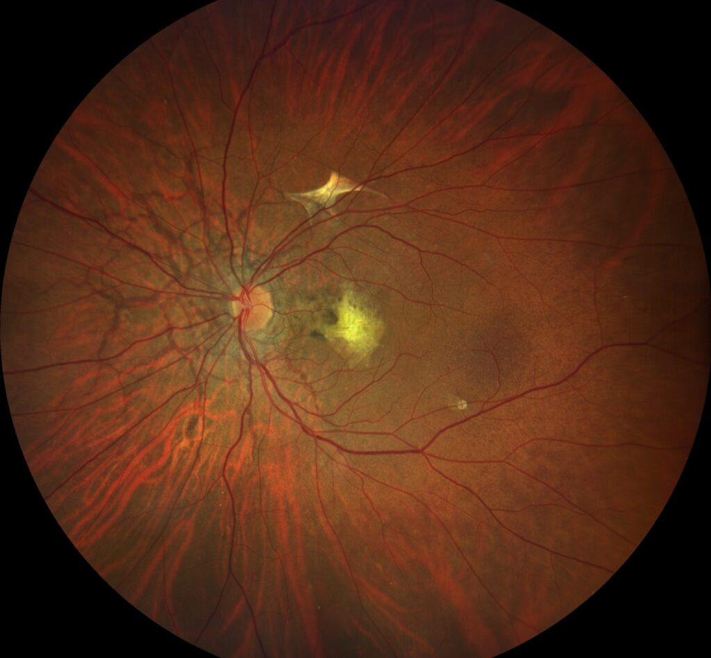 Clinical image illustrating Bruch’s Membrane (figure 1)