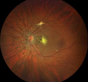 Clinical image illustrating Bruch’s Membrane (figure 1)