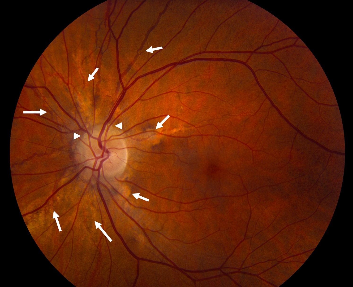 Clinical image illustrating Bruch’s Membrane (figure 2)