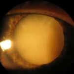 Clinical eye photograph illustrating Brunescent Cataract Cataracta Nigra