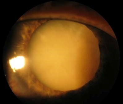 Brunescent Cataract (Cataracta Nigra): The Hard, Dark Nucleus and What It Means for Surgery