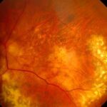 Clinical eye photograph illustrating Candle Wax Drippings Sarcoid Periphlebitis