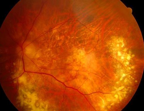 Candle Wax Drippings: Periphlebitis in Sarcoid Uveitis and What the Sheathing Looks Like