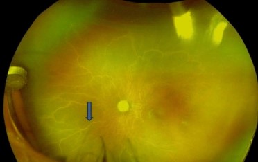 Clinical eye photograph illustrating Candle Wax Drippings Sarcoid Periphlebitis