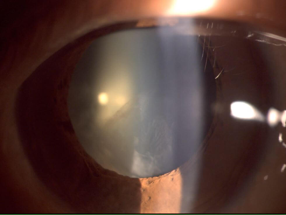 Clinical image illustrating Cataract After Vitrectomy
