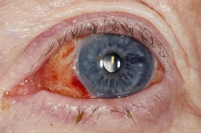 Cataract Surgery and Anticoagulants: Safe Practice
